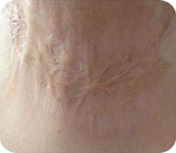 Calla-Find Silicone Pad Scar Treatment best Anti Scar Cream On Calla-6