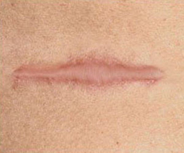Calla-Find Silicone Pad Scar Treatment best Anti Scar Cream On Calla-11