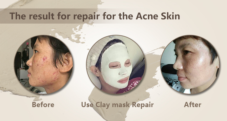 Calla-Skin Care Recipe: Prevent Sensitive Skin Redness In Autumn And Winter News-4