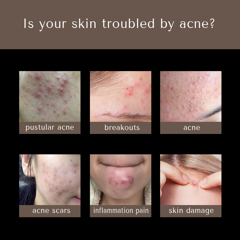 news-Calla-acne patch-img-1