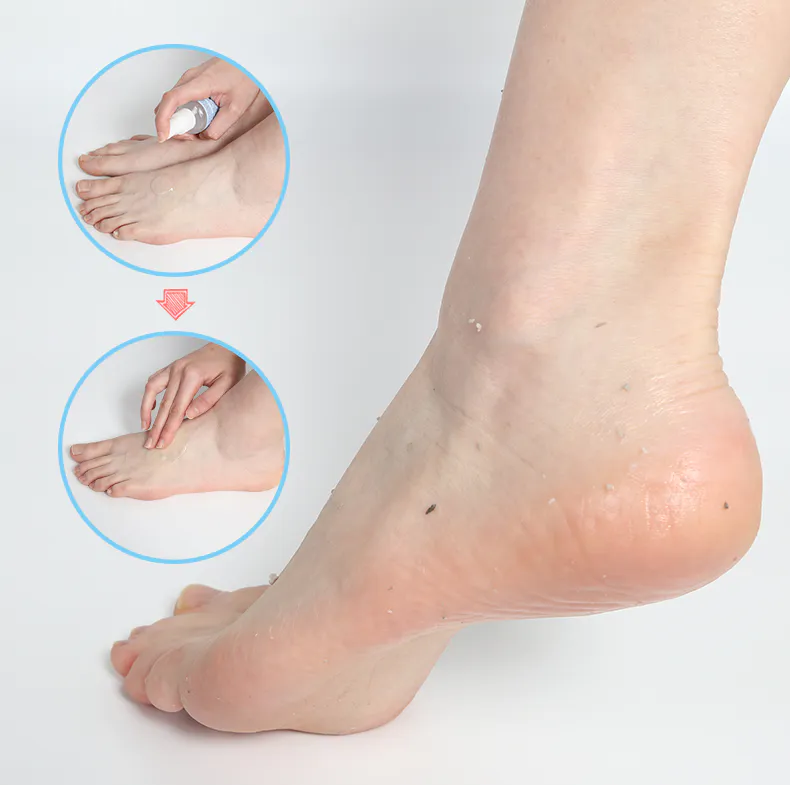 Feet instant foot peeling spray