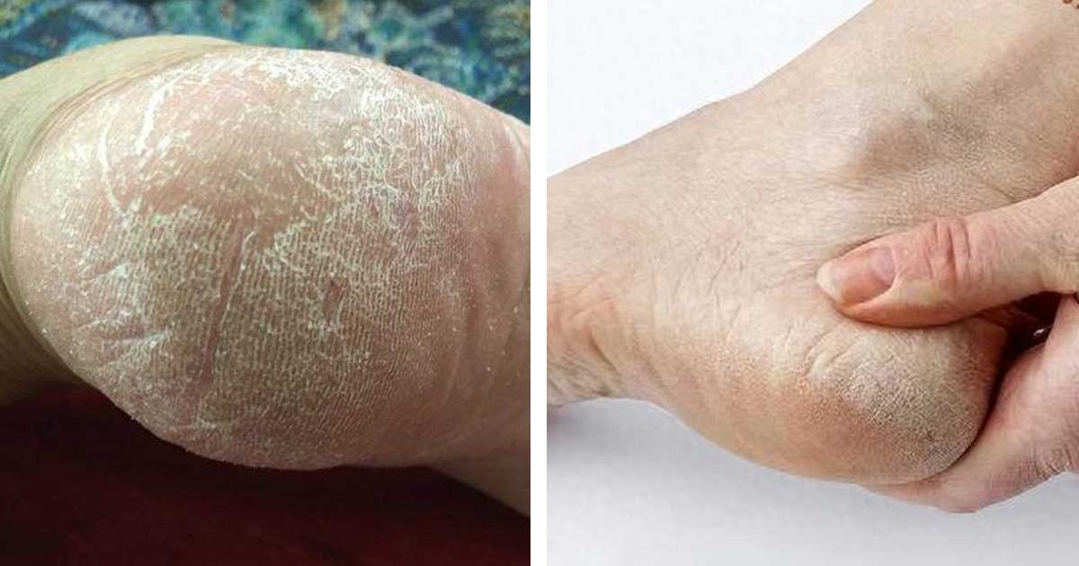 news-Calla-Why use a peeling foot mask and how does it work-img