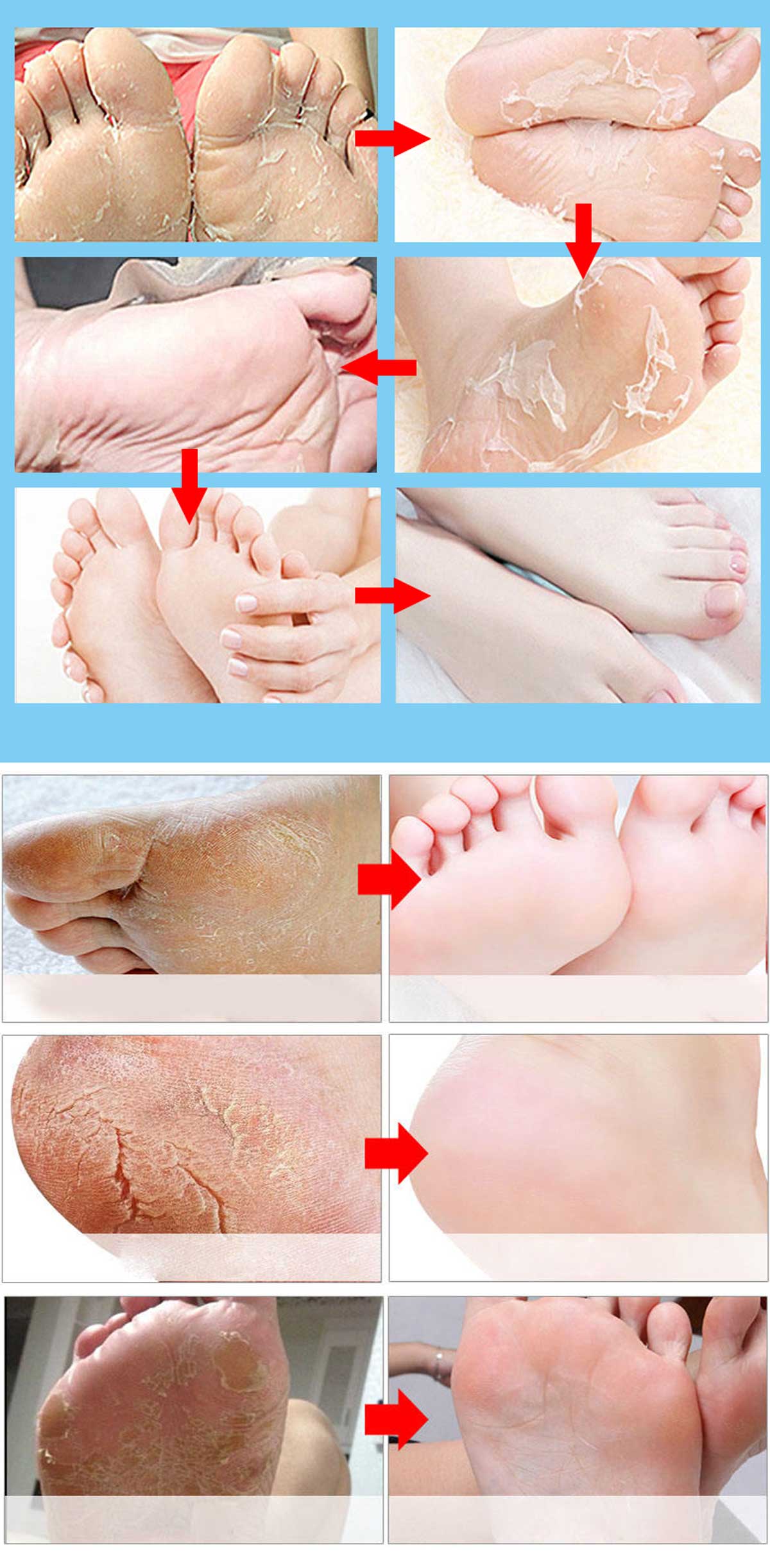 news-Why use a peeling foot mask and how does it work-Calla-img-1