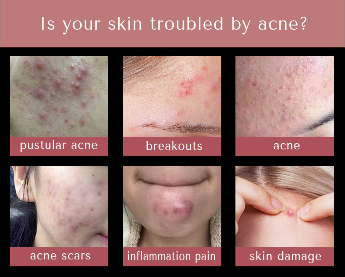 acne pimple patch