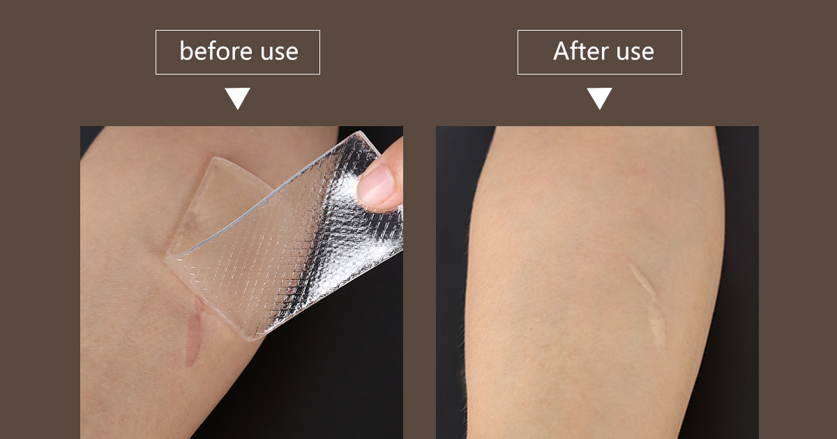 scar silicone gel patch