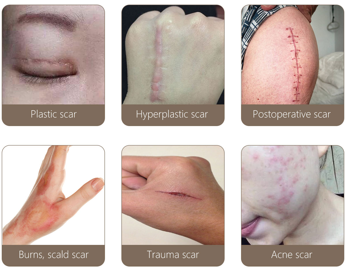 scar silicone gel patch