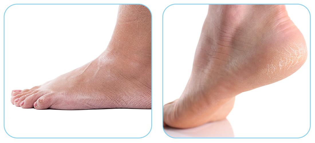 Feet instant foot peeling spray