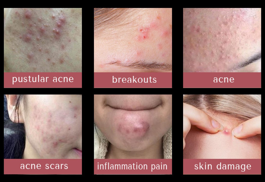 pimple patch