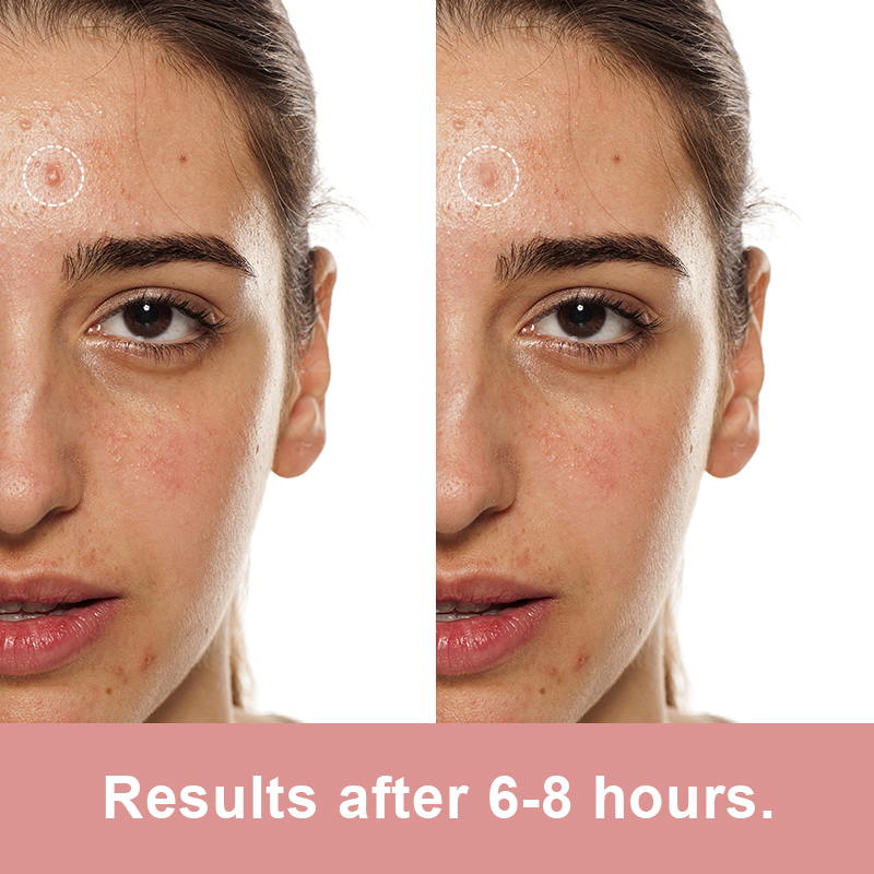 pimple patches for face hydrocolloid acne patches